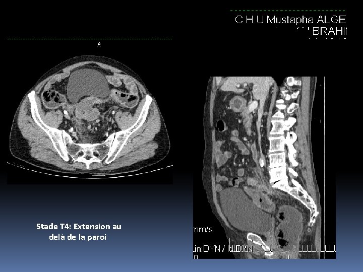 Stade T 4: Extension au delà de la paroi 