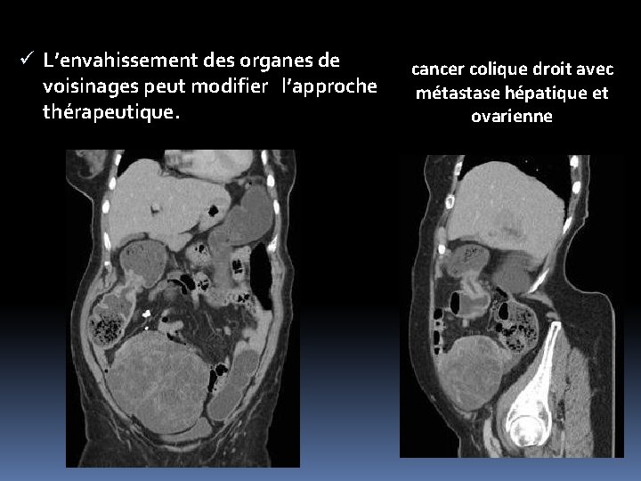 ü L’envahissement des organes de voisinages peut modifier l’approche thérapeutique. cancer colique droit avec