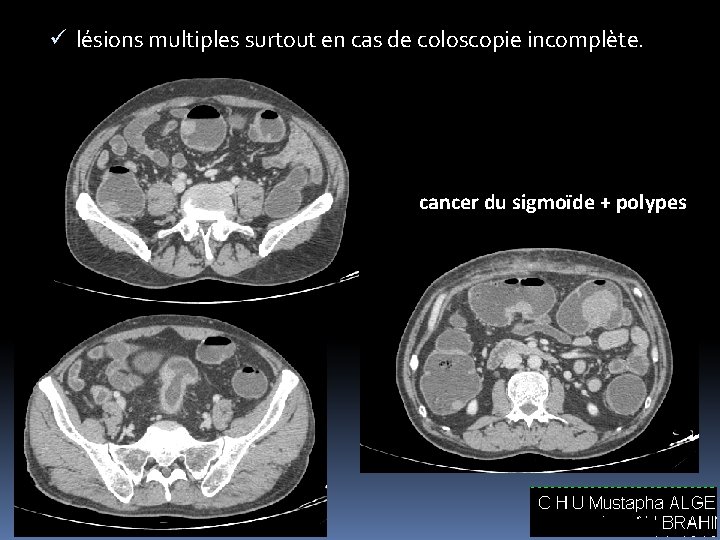 ü lésions multiples surtout en cas de coloscopie incomplète. cancer du sigmoïde + polypes