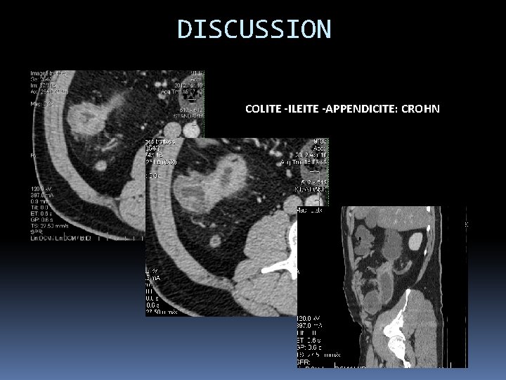 DISCUSSION COLITE -ILEITE -APPENDICITE: CROHN 