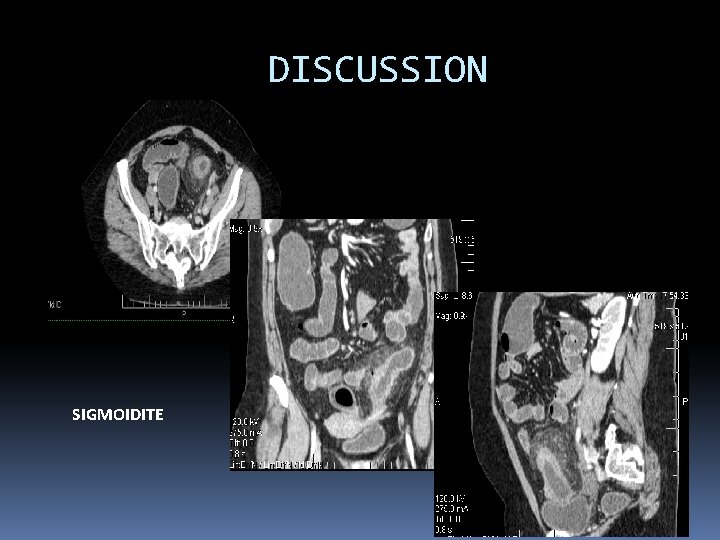 DISCUSSION SIGMOIDITE 