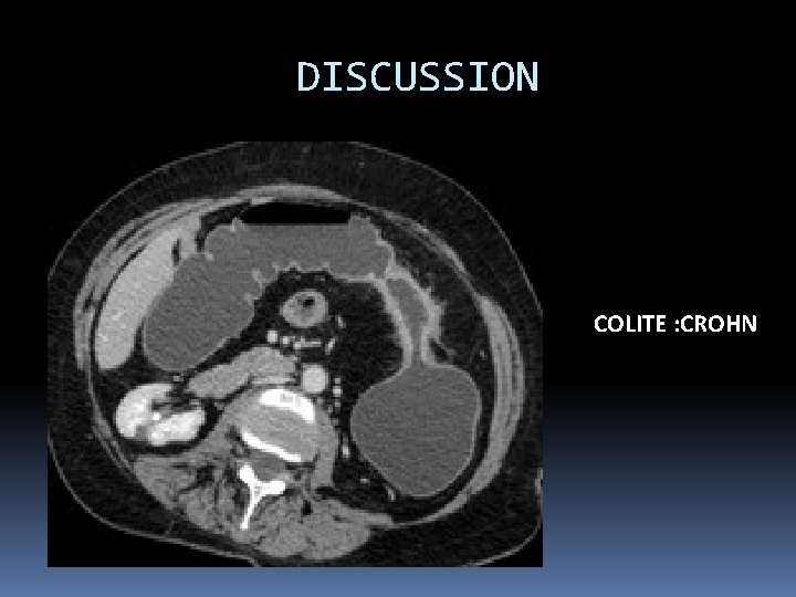 DISCUSSION COLITE : CROHN 