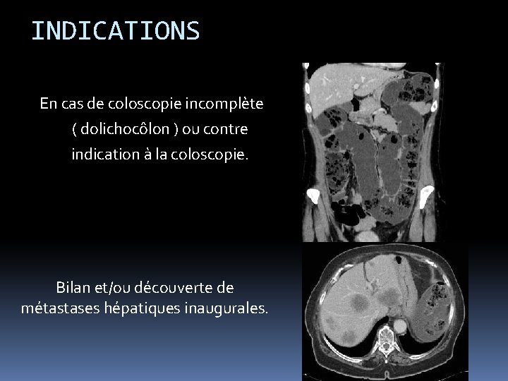 INDICATIONS En cas de coloscopie incomplète ( dolichocôlon ) ou contre indication à la