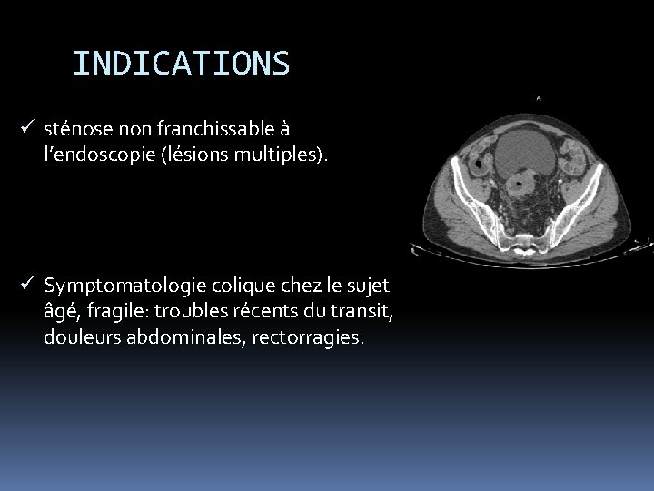 INDICATIONS ü sténose non franchissable à l’endoscopie (lésions multiples). ü Symptomatologie colique chez le