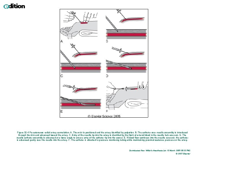 Figure 32 -4 Percutaneous radial artery cannulation. A, The wrist is positioned and the