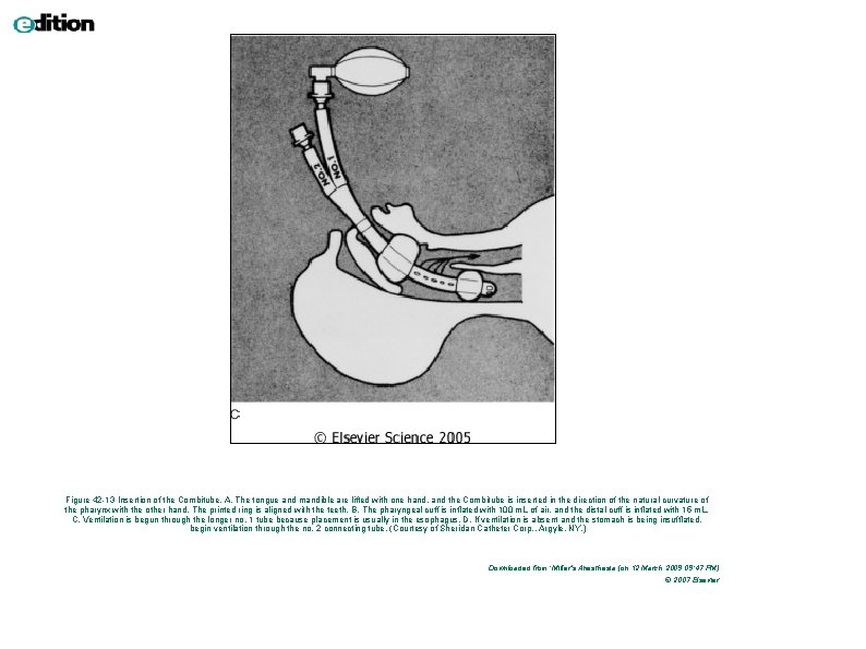 Figure 42 -13 Insertion of the Combitube. A, The tongue and mandible are lifted