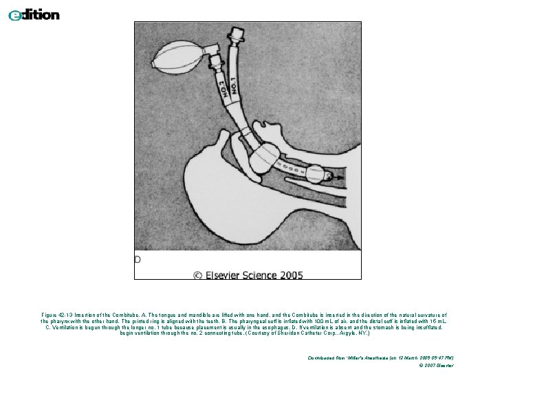 Figure 42 -13 Insertion of the Combitube. A, The tongue and mandible are lifted
