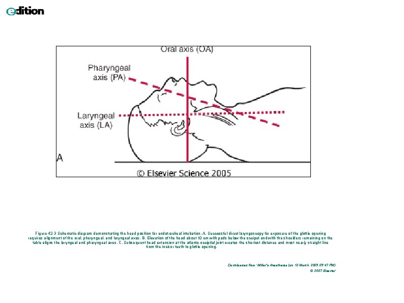 Figure 42 -3 Schematic diagram demonstrating the head position for endotracheal intubation. A, Successful