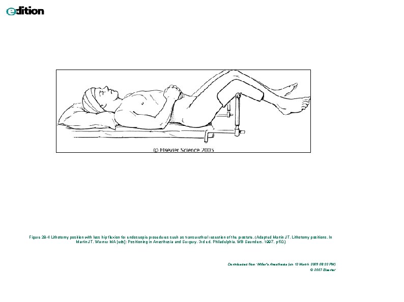 Figure 28 -4 Lithotomy position with less hip flexion for endoscopic procedures such as