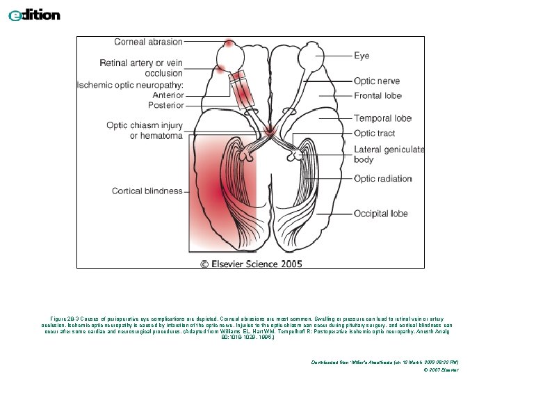 Figure 28 -3 Causes of perioperative eye complications are depicted. Corneal abrasions are most