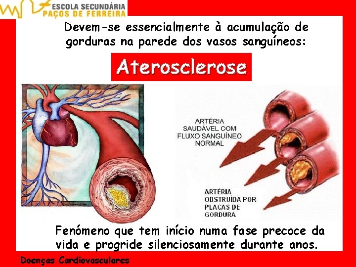 Devem-se essencialmente à acumulação de gorduras na parede dos vasos sanguíneos: Aterosclerose Fenómeno que