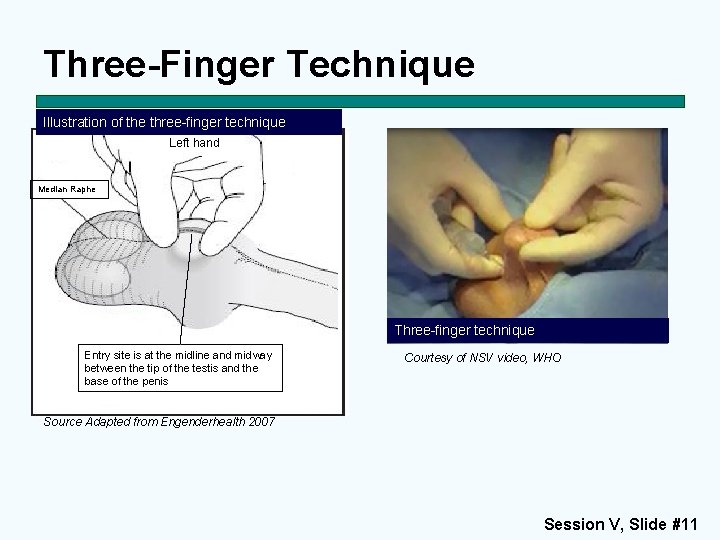 Three-Finger Technique Illustration of the three-finger technique Left hand Median Raphe Three-finger technique Entry