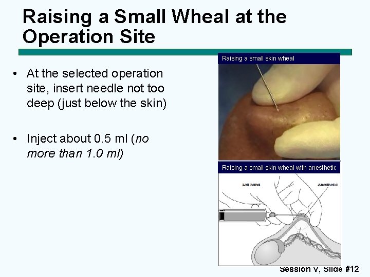 Raising a Small Wheal at the Operation Site Raising a small skin wheal •
