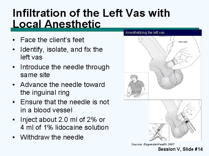 Infiltration of the Left Vas with Local Anesthetic Anesthetizing the left vas • Face