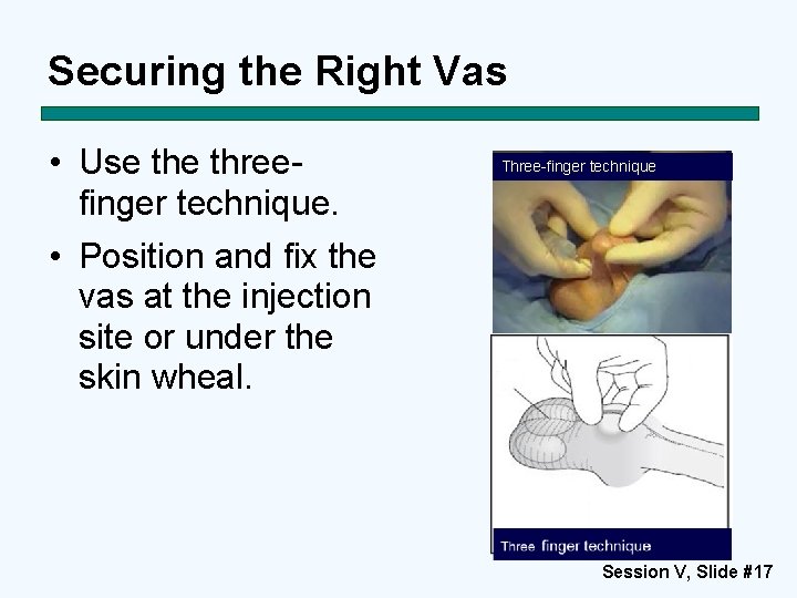 Securing the Right Vas • Use threefinger technique. • Position and fix the vas