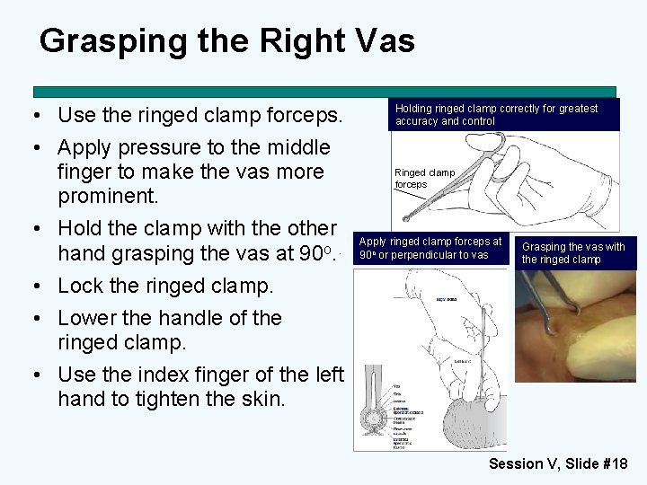 Grasping the Right Vas • Use the ringed clamp forceps. • Apply pressure to