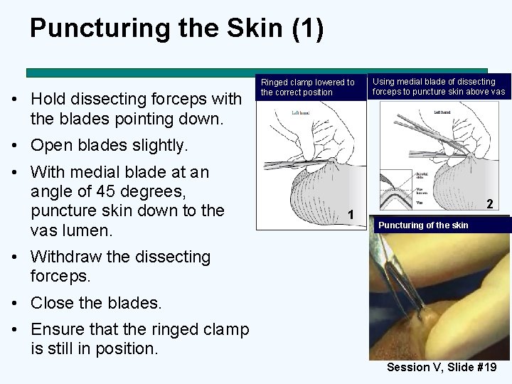 Puncturing the Skin (1) • Hold dissecting forceps with the blades pointing down. Ringed
