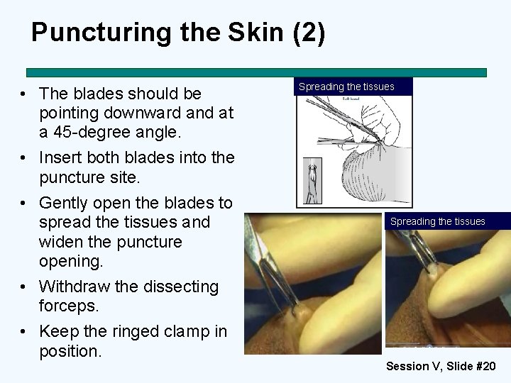 Puncturing the Skin (2) • The blades should be pointing downward and at a