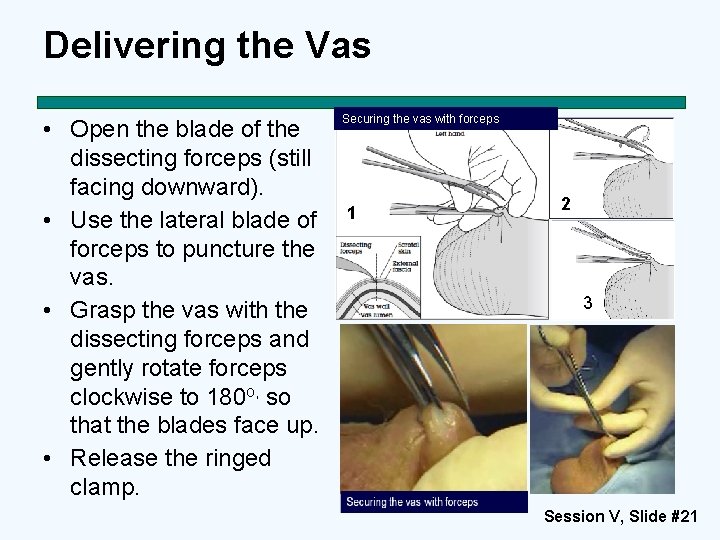 Delivering the Vas • Open the blade of the dissecting forceps (still facing downward).