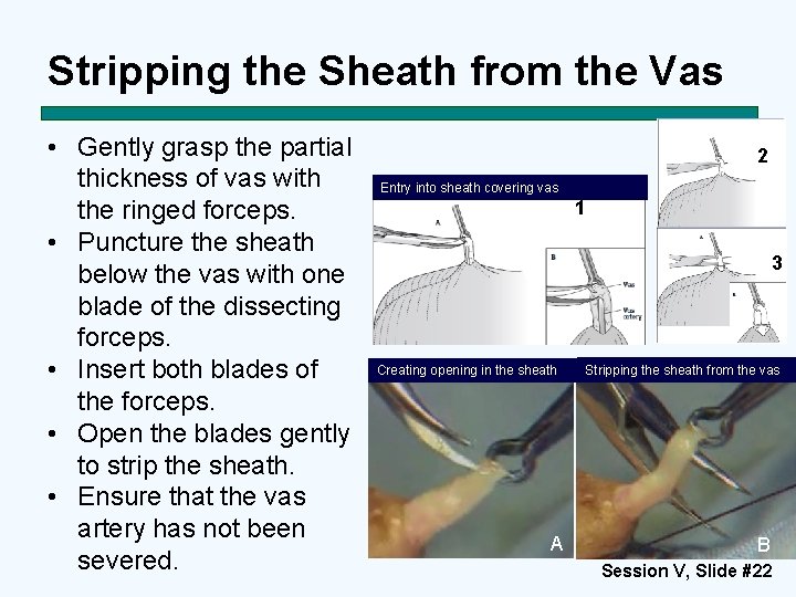 Stripping the Sheath from the Vas • Gently grasp the partial thickness of vas