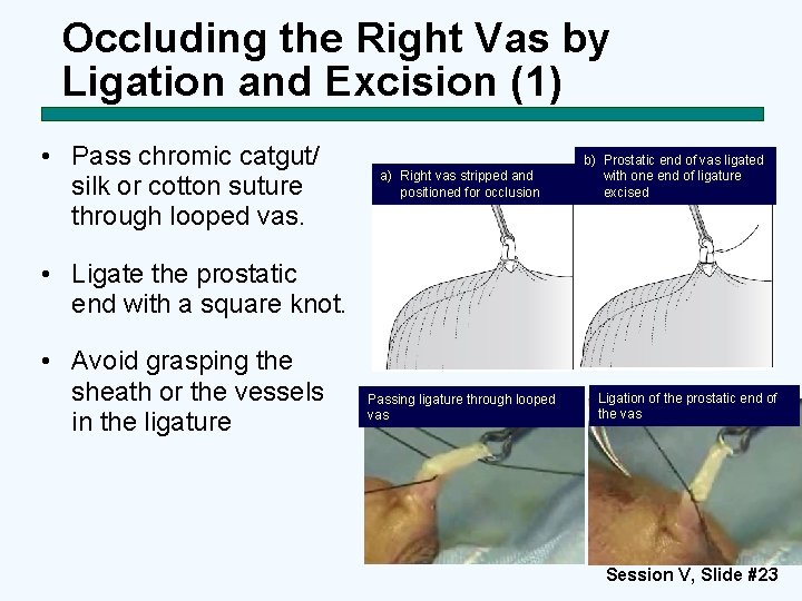 Occluding the Right Vas by Ligation and Excision (1) • Pass chromic catgut/ silk