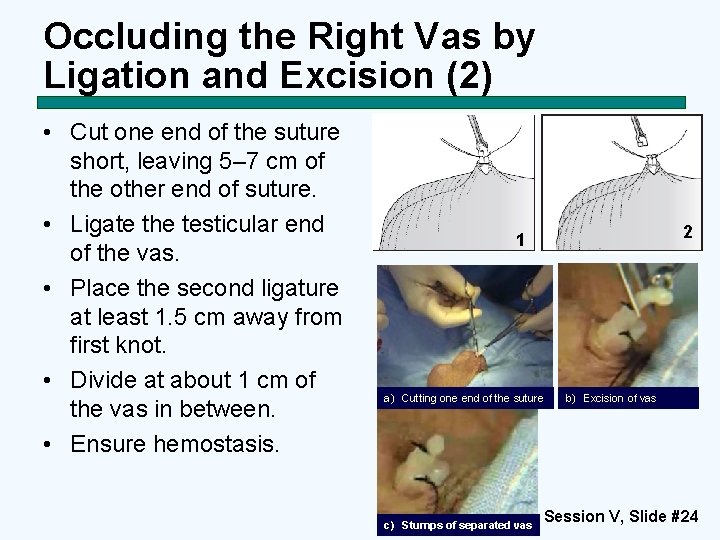 Occluding the Right Vas by Ligation and Excision (2) • Cut one end of