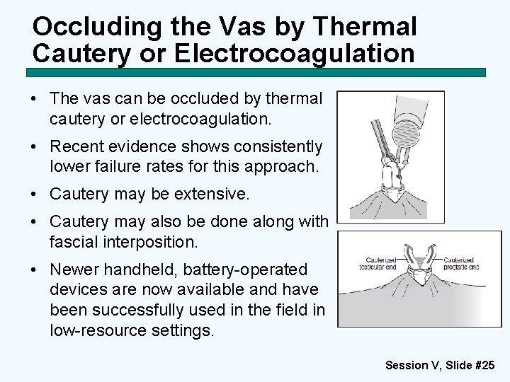 Occluding the Vas by Thermal Cautery or Electrocoagulation • The vas can be occluded