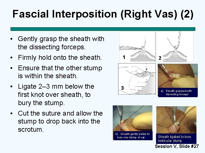 Fascial Interposition (Right Vas) (2) • Gently grasp the sheath with the dissecting forceps.