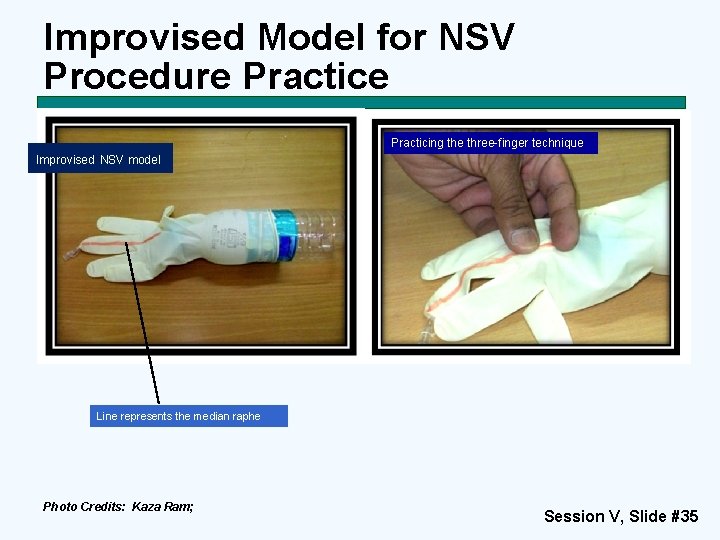 Improvised Model for NSV Procedure Practicing the three-finger technique Improvised NSV model Line represents