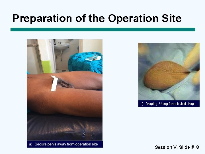 Preparation of the Operation Site b) Draping: Using fenestrated drape Session V, Slide #