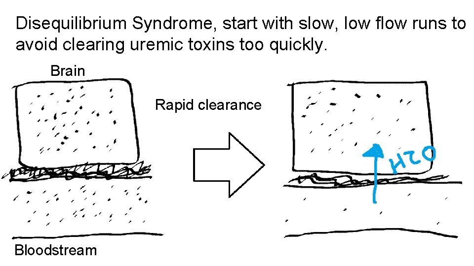 Disequilibrium Syndrome, start with slow, low flow runs to avoid clearing uremic toxins too