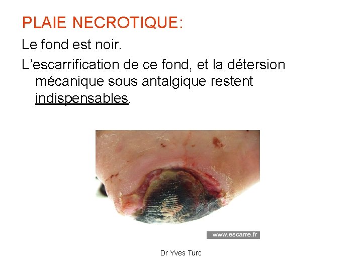 PLAIE NECROTIQUE: Le fond est noir. L’escarrification de ce fond, et la détersion mécanique