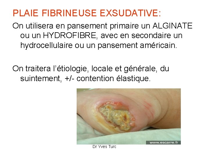 PLAIE FIBRINEUSE EXSUDATIVE: On utilisera en pansement primaire un ALGINATE ou un HYDROFIBRE, avec