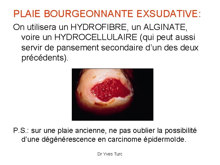 PLAIE BOURGEONNANTE EXSUDATIVE: On utilisera un HYDROFIBRE, un ALGINATE, voire un HYDROCELLULAIRE (qui peut