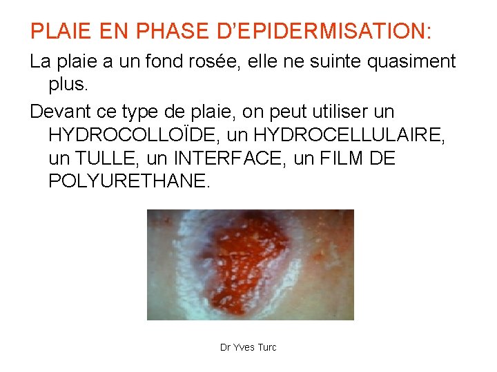 PLAIE EN PHASE D’EPIDERMISATION: La plaie a un fond rosée, elle ne suinte quasiment