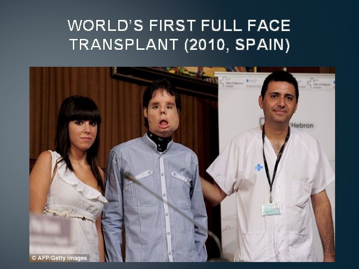 WORLD’S FIRST FULL FACE TRANSPLANT (2010, SPAIN) 