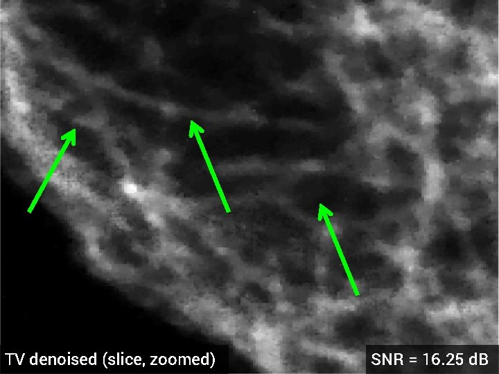 TV denoised (slice, zoomed) SNR = 16. 25 d. B 
