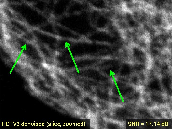 HDTV 3 denoised (slice, zoomed) SNR = 17. 14 d. B 