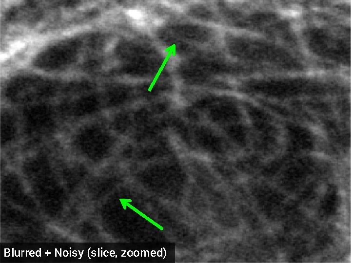 Blurred + Noisy (slice, zoomed) 