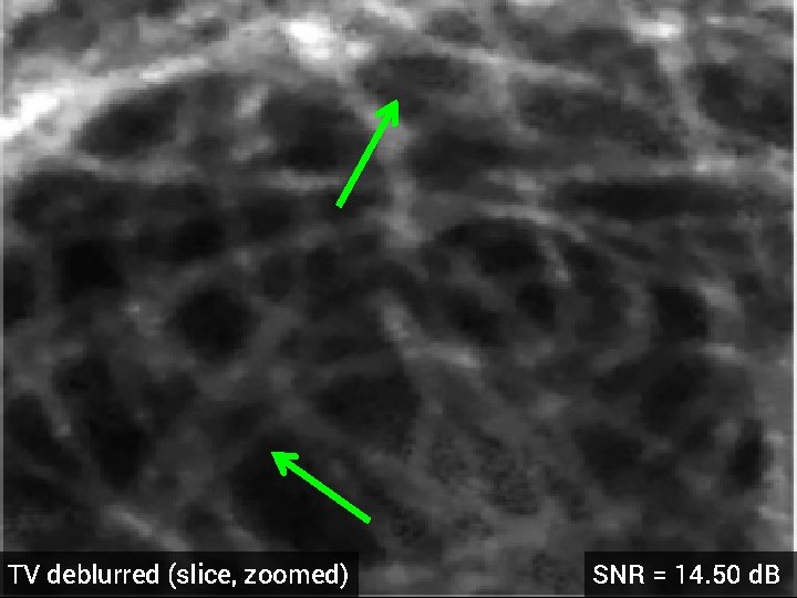 TV deblurred (slice, zoomed) SNR = 14. 50 d. B 
