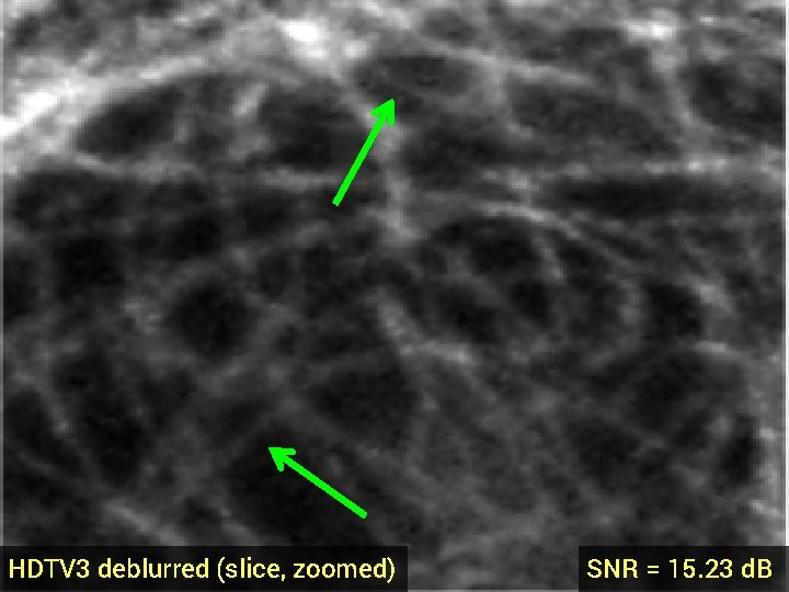 HDTV 3 deblurred (slice, zoomed) SNR = 15. 23 d. B 