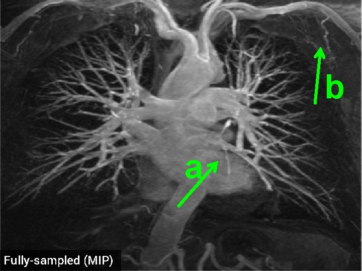 b a Fully-sampled (MIP) 