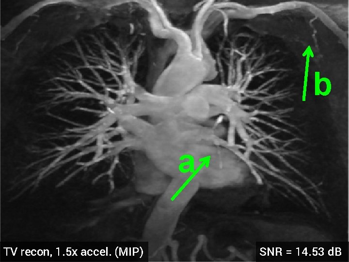 b a TV recon, 1. 5 x accel. (MIP) SNR = 14. 53 d.