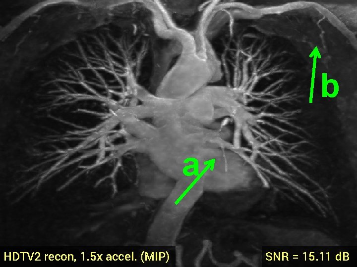 b a HDTV 2 recon, 1. 5 x accel. (MIP) SNR = 15. 11