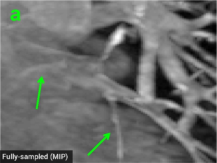 a Fully-sampled (MIP) 