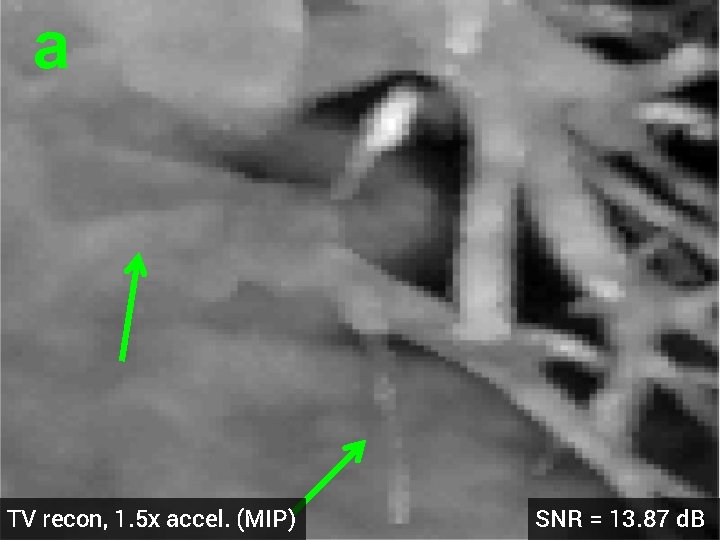 a TV recon, 1. 5 x accel. (MIP) SNR = 13. 87 d. B