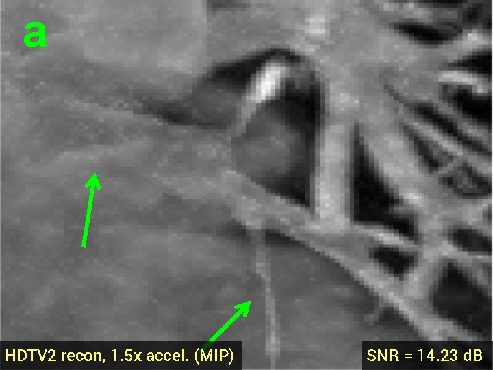 a HDTV 2 recon, 1. 5 x accel. (MIP) SNR = 14. 23 d.