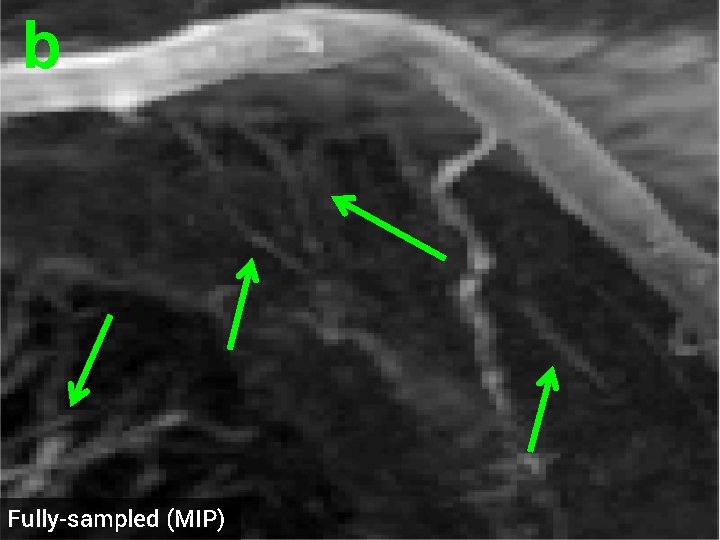 b Fully-sampled (MIP) 