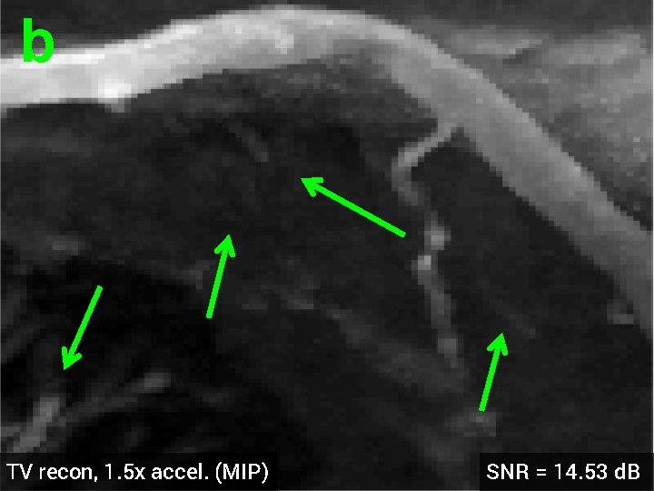 b TV recon, 1. 5 x accel. (MIP) SNR = 14. 53 d. B
