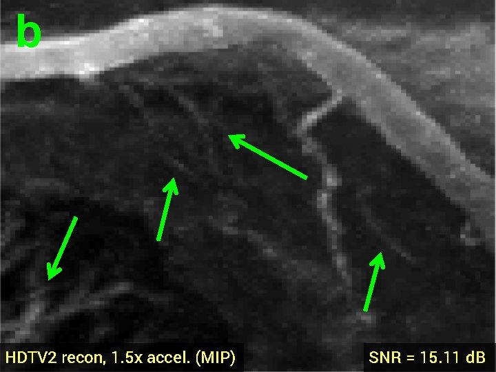 b HDTV 2 recon, 1. 5 x accel. (MIP) SNR = 15. 11 d.